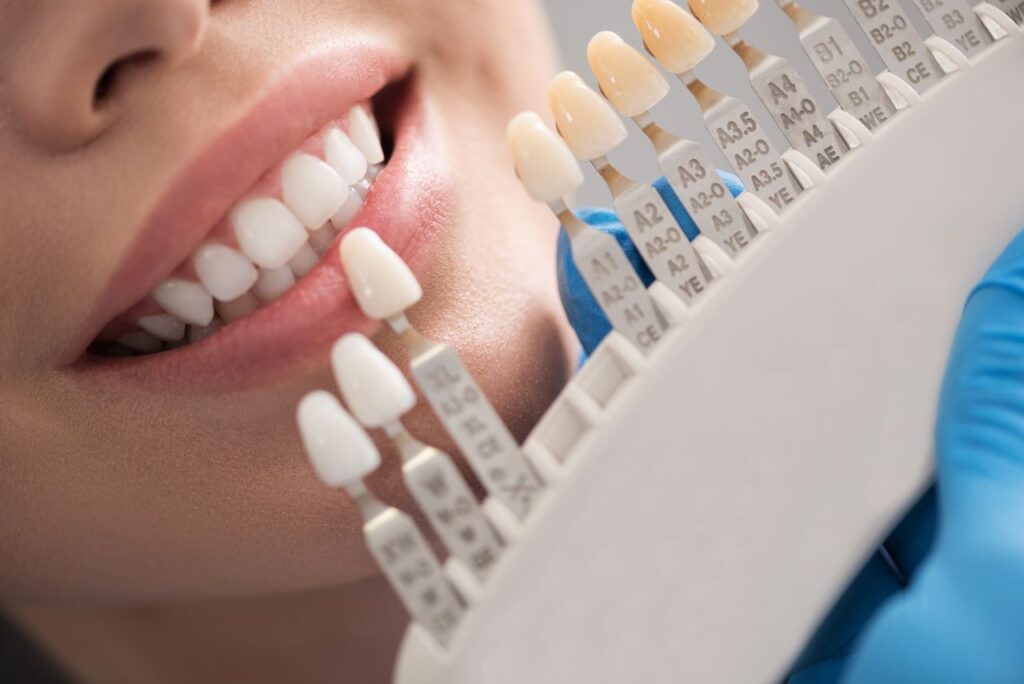 Corone dentali a Brescia per sostituire i denti naturali