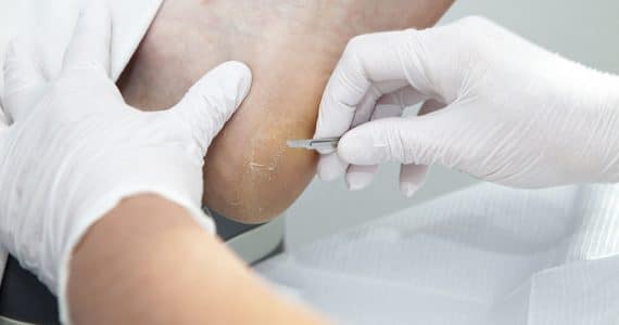 Ipercheratosi: cause, sintomi e trattamento 11 Ipercheratosi: cause, sintomi e trattamento