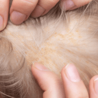 La dermatite seborroica può causare la perdita di capelli?