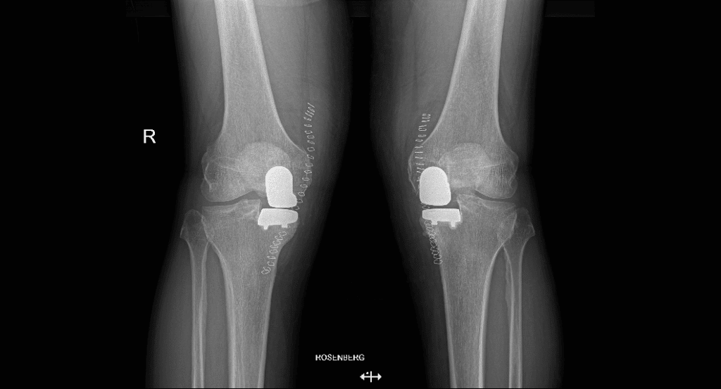 Protesi monocompartimentale mininvasiva bilaterale di ginocchio