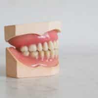 Protesi dentarie: cosa sono, quali scegliere, quanto costano