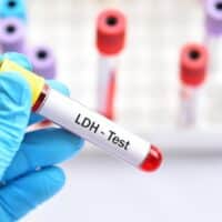 Test LDH: che cos’è e a cosa serve il test