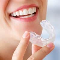 Bite dentale, tutto ciò che c’è da sapere sull’apparecchio per la salute dei denti