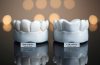 Corone in zirconia e ceramica – vantaggi estetici e durata. Il confronto tra i materiali più usati nella ricostruzione protesica.